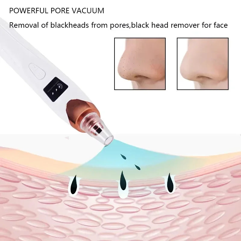 Electric Blackhead Remover Vacuum – USB Rechargeable Pore Cleaner with 3 Suction Levels & 5 Heads | Acne Extractor & Deep Facial Cleansing Tool